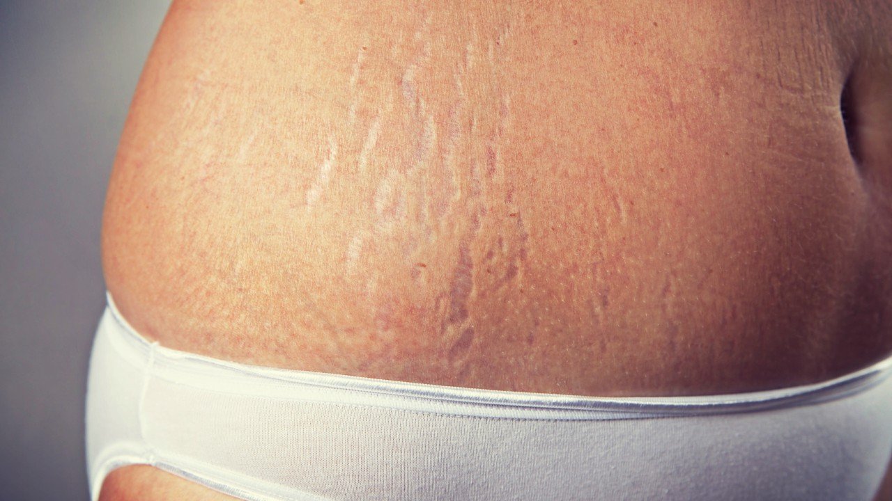 stretch-marks